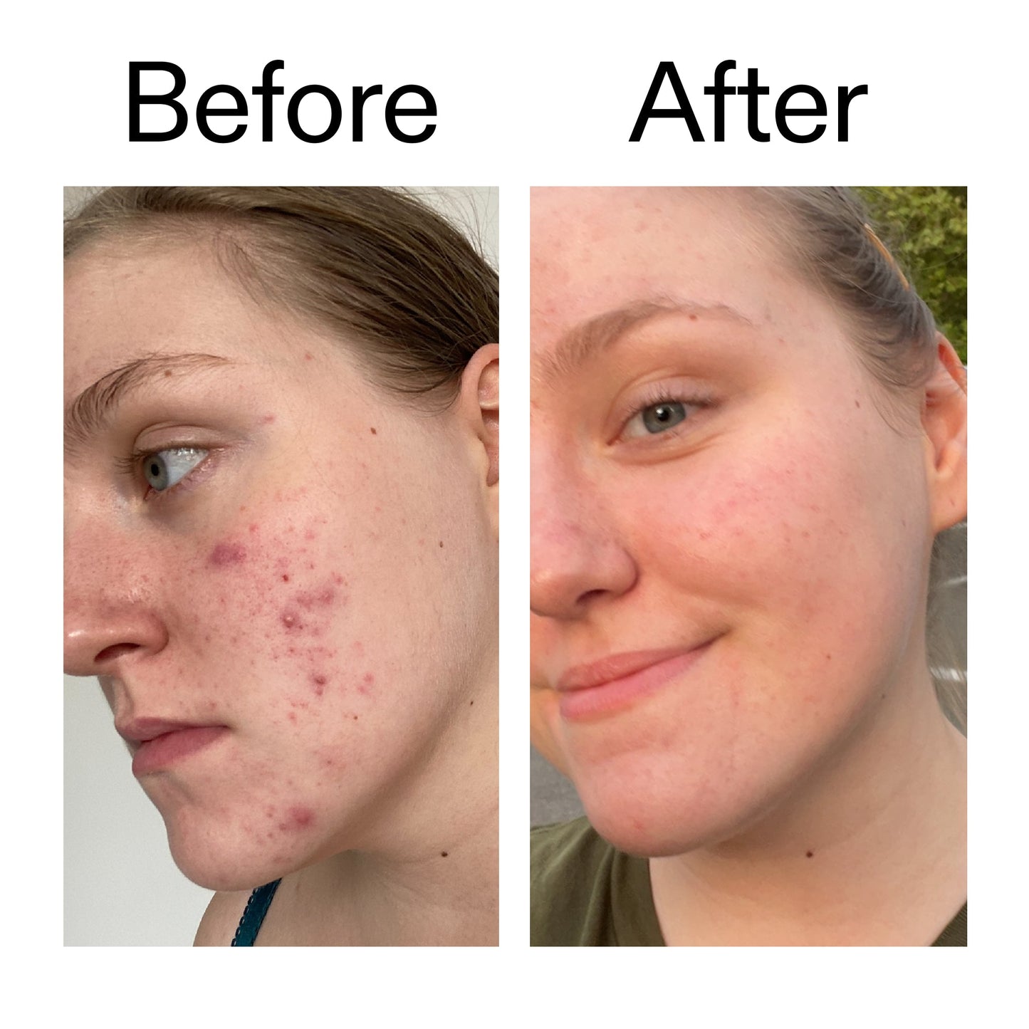 glycolic-acid-toner-s9 Glycolic_Acid_Toner_Before_After_2000x2000_49f0b9f7-e71b-4b2e-a8f8-2ea4b73247bb.jpg
