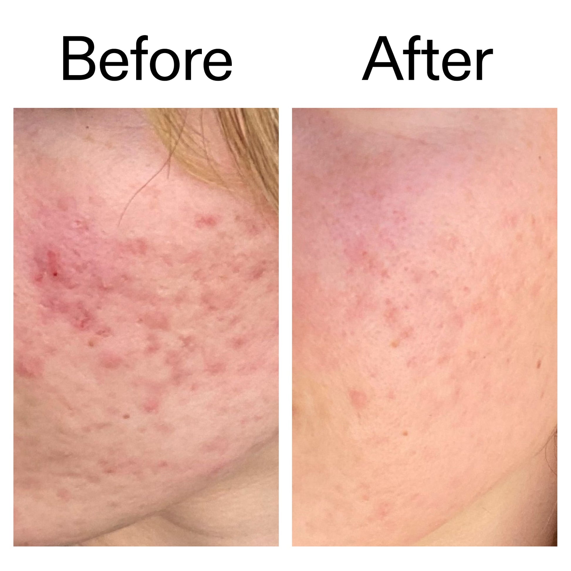 10-azelaic-acid-serum-for-redness-relief-a2 Azealic_Acid_Serum_B_A_Ppage_2000_x_2000.jpg