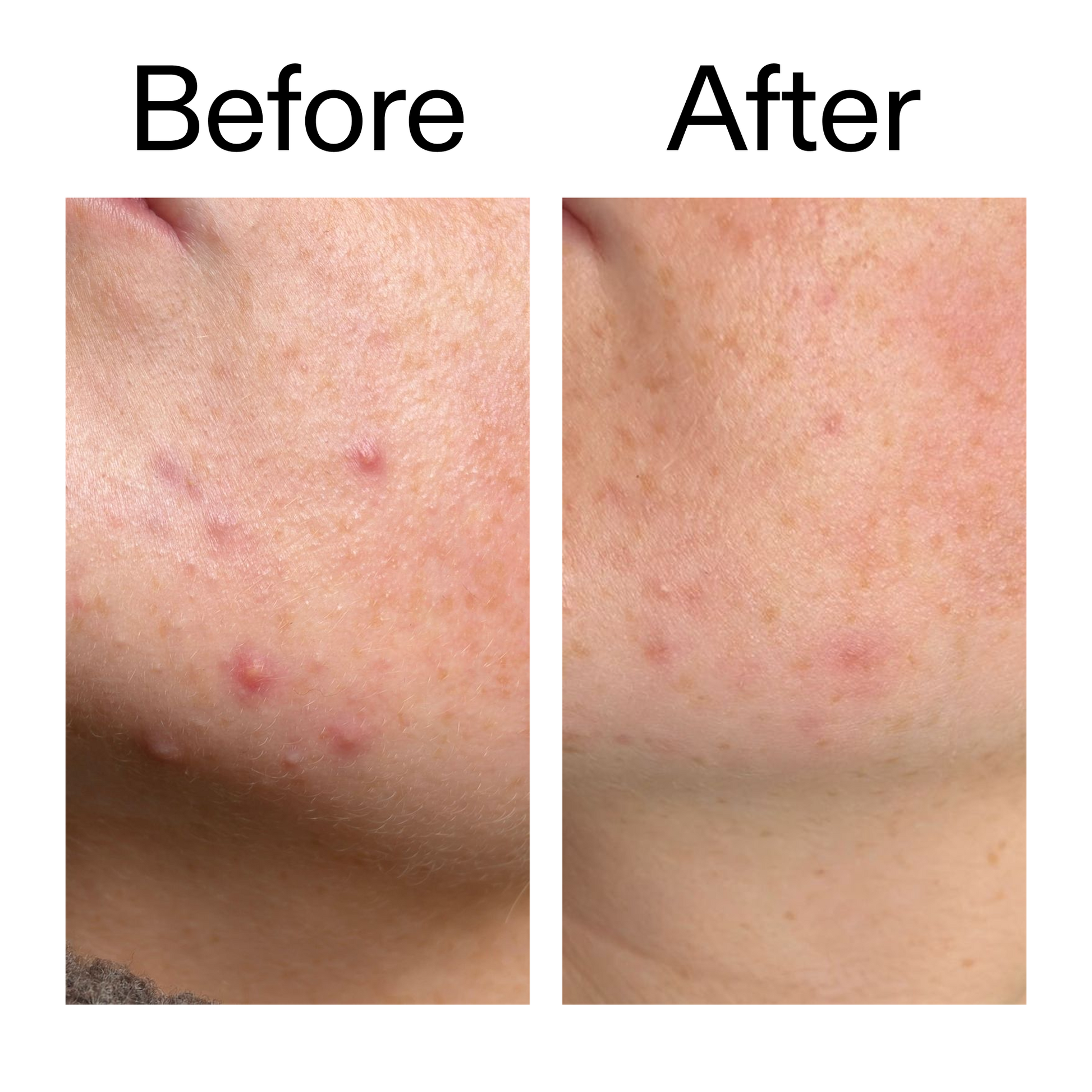 10-azelaic-acid-serum-for-redness-relief-a2 B_A_1_PPAGE.png