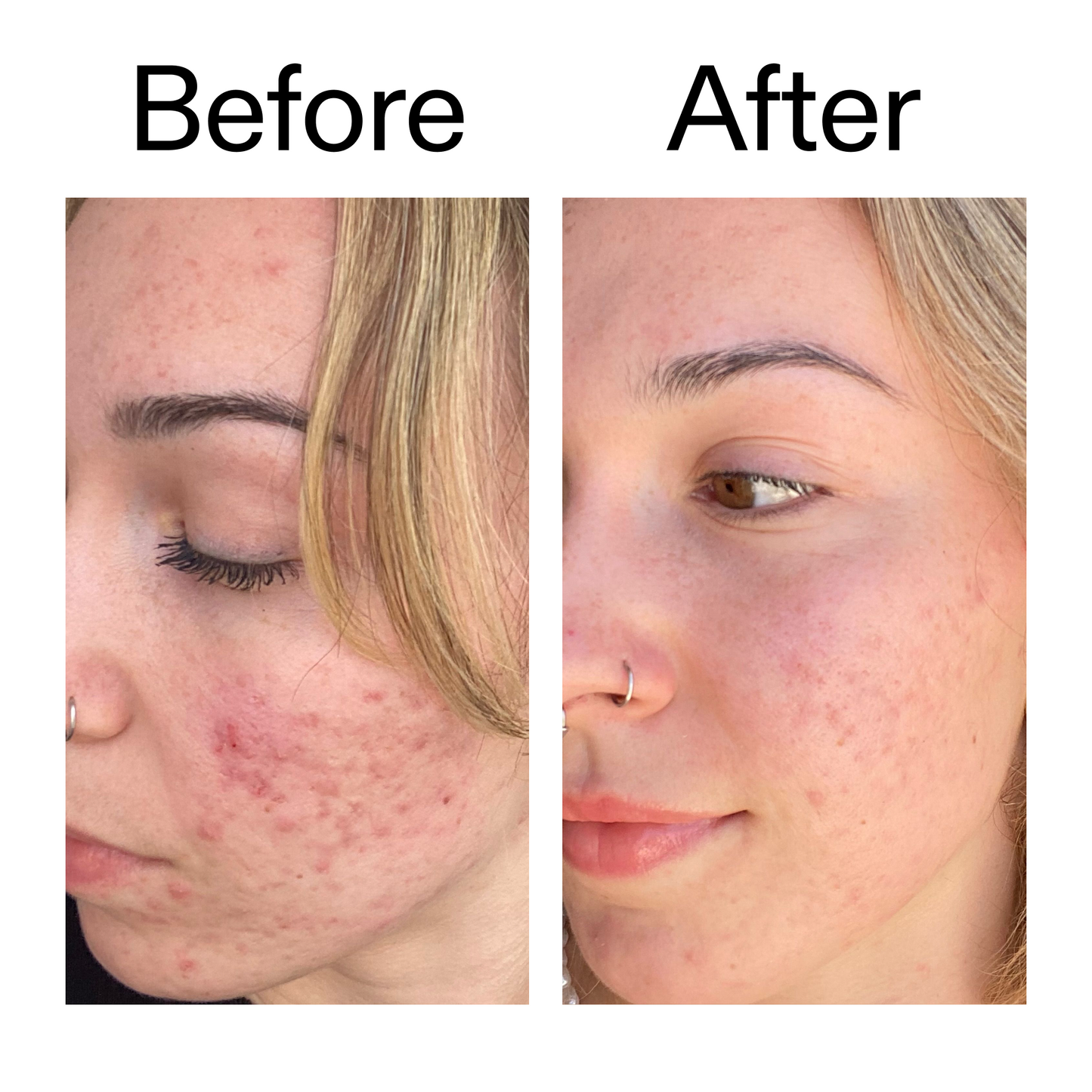 10-azelaic-acid-serum-for-redness-relief-a2 B_A_2_PPAGE.png