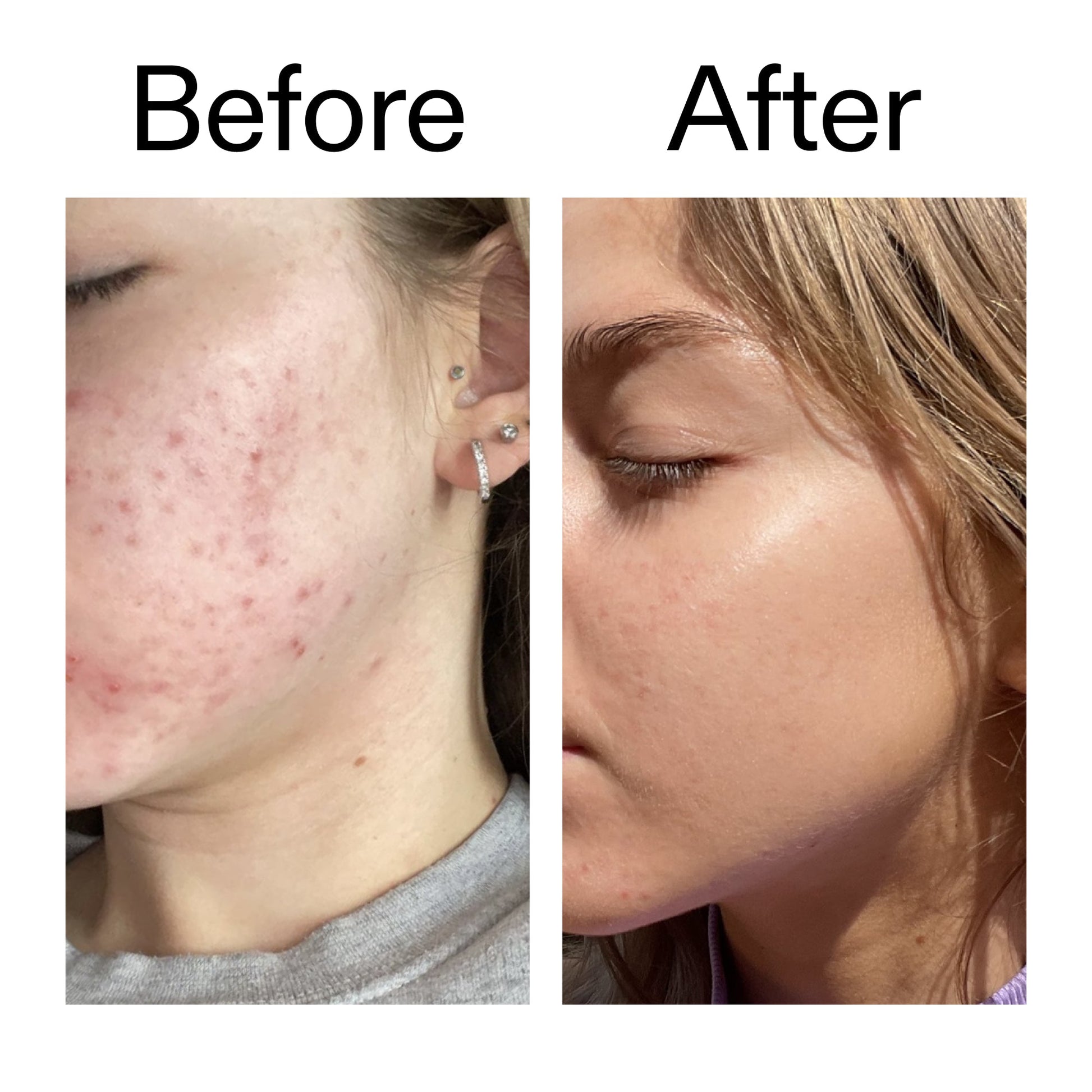 beta-hydroxy-acid-bha-serum-i5 Beta_Hydroxy_Acid_Serum_Before_After_2000x2000_96fda3e5-938d-49ef-bcf2-a0fa6ece4e2c.jpg
