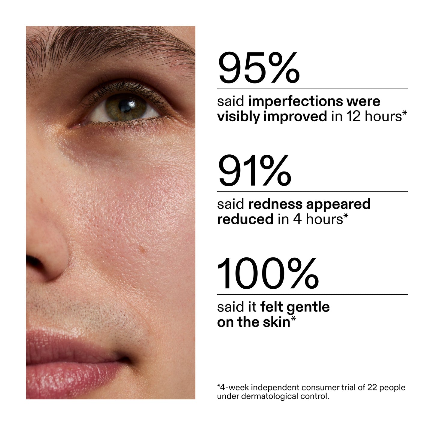 succinic-acid-acne-treatment-e6 CA_Succinic_Acid_Treatment_key_Claims_2000x2000_db91b0f1-7f29-4bfe-bb16-63a47f500960.jpg