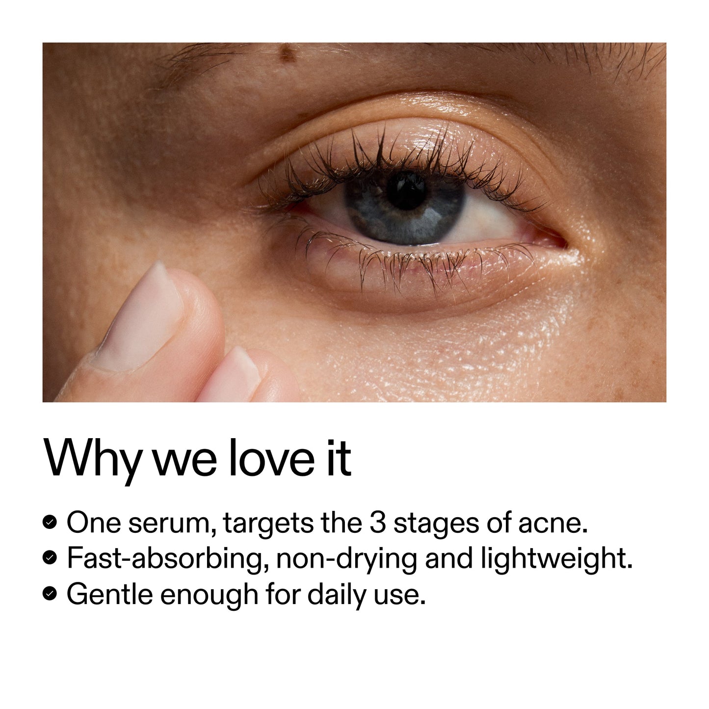 360-acne-clearing-serum-y4 Dioic_Whyweloveit_2000x2000_175aafd3-0cbe-403a-b317-a8362881bfe2.jpg