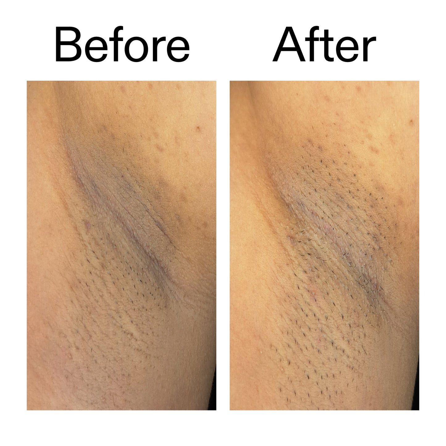 glycolic-acid-exfoliating-body-stick-n8 Glycolic_Acid_Exfoliating_Body_Stick_Before_After_V3_2000x2000_ea919cd9-1439-4a46-82a0-76200eb5bb42.jpg