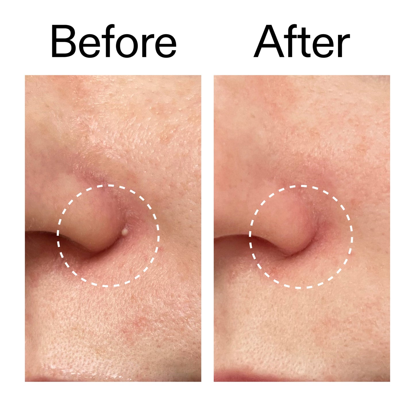 hydrocolloid-invisible-pimple-patches-pack-of-44-r6 Hydrocolloid_Invisible_Pimple_Patches_Before_After_2000x2000_b02aa37b-c78a-4682-91de-9135af5bb7df.jpg