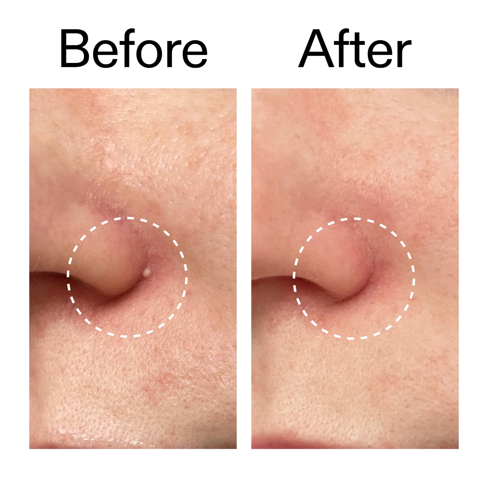 hydrocolloid-invisible-pimple-patches-pack-of-44-r6 Hydrocolloid_Invisible_Pimple_Patches_Before_After_2000x2000_b02aa37b-c78a-4682-91de-9135af5bb7df.jpg