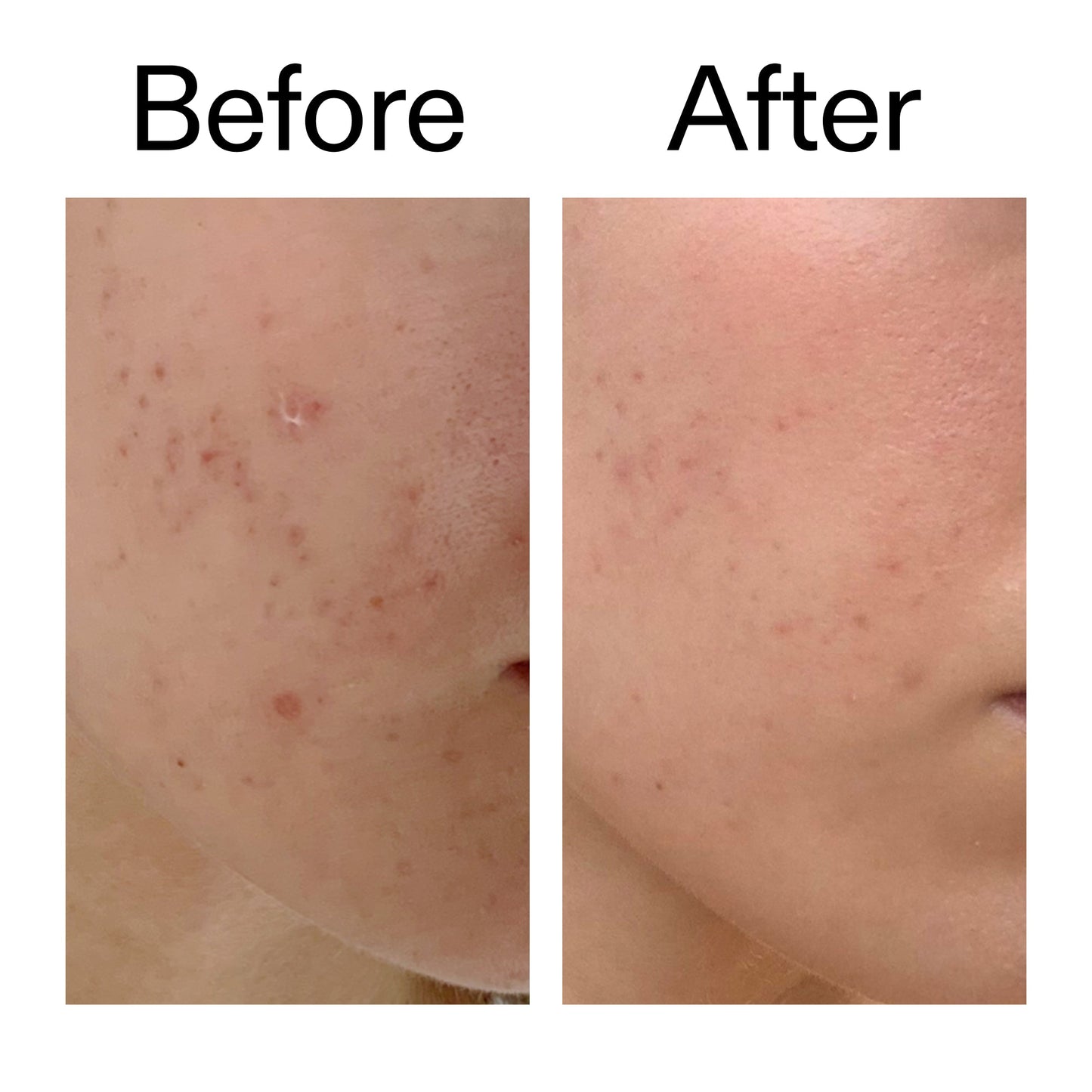 mandelic-acid-treatment-e7 Mandelic_Acid_Treatment_Before_After_2000x2000_4885ac6e-c5d7-4279-a72a-1417af7dce35.jpg