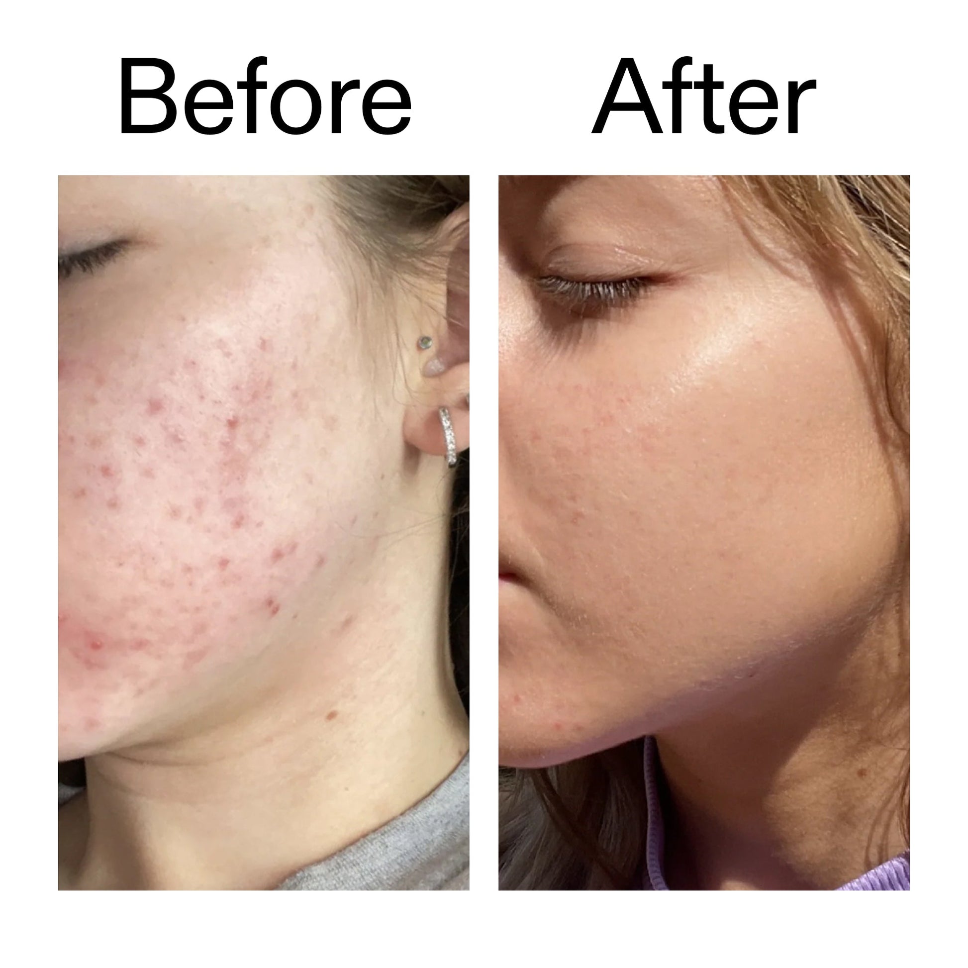 10-niacinamide-serum-duo-f5 Niacinamide_Serum_Before_After_2000x2000_bde32455-9e7d-448e-b053-bef41504f0a9.jpg