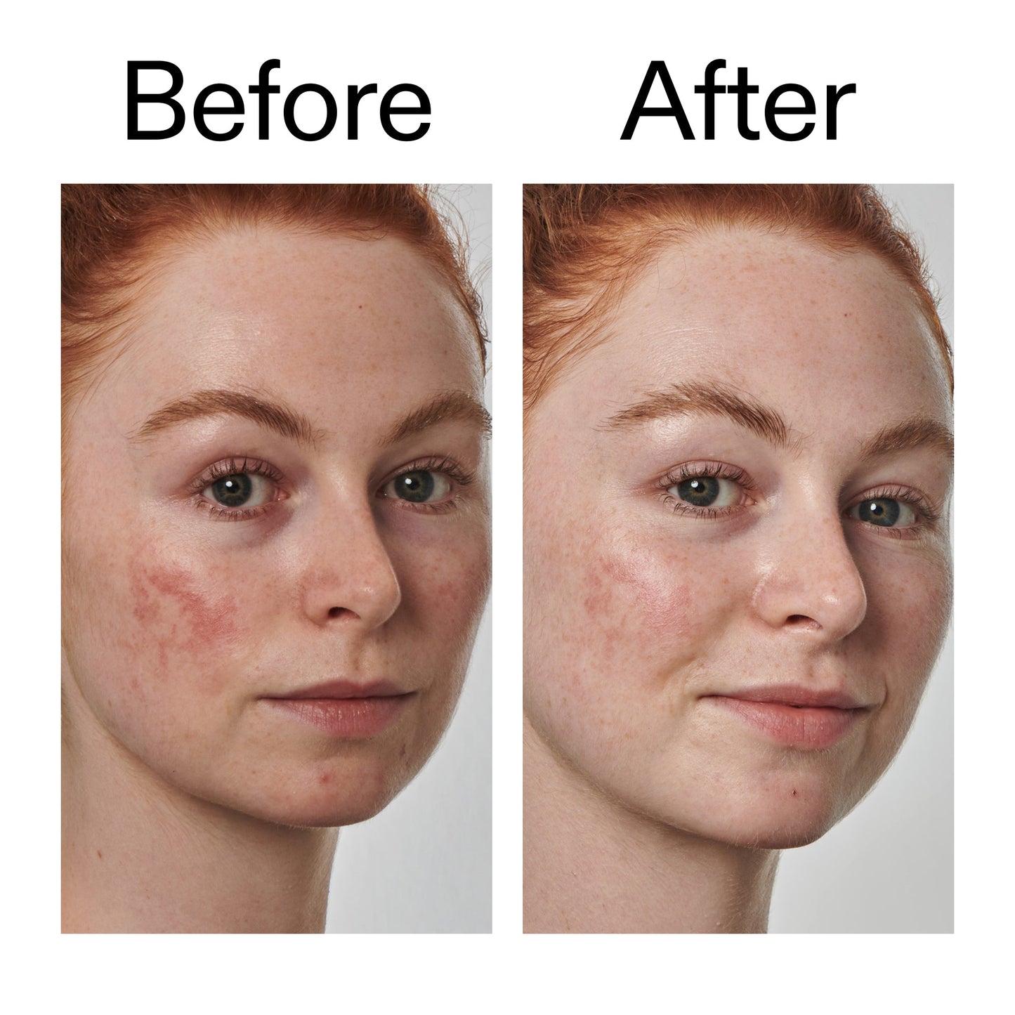10-azelaic-acid-serum-for-redness-relief-a2 Redness_Relief_Serum_Before_After_2000x2000_3334dc9a-cce9-4e00-8aec-7ad89ca051f2.jpg