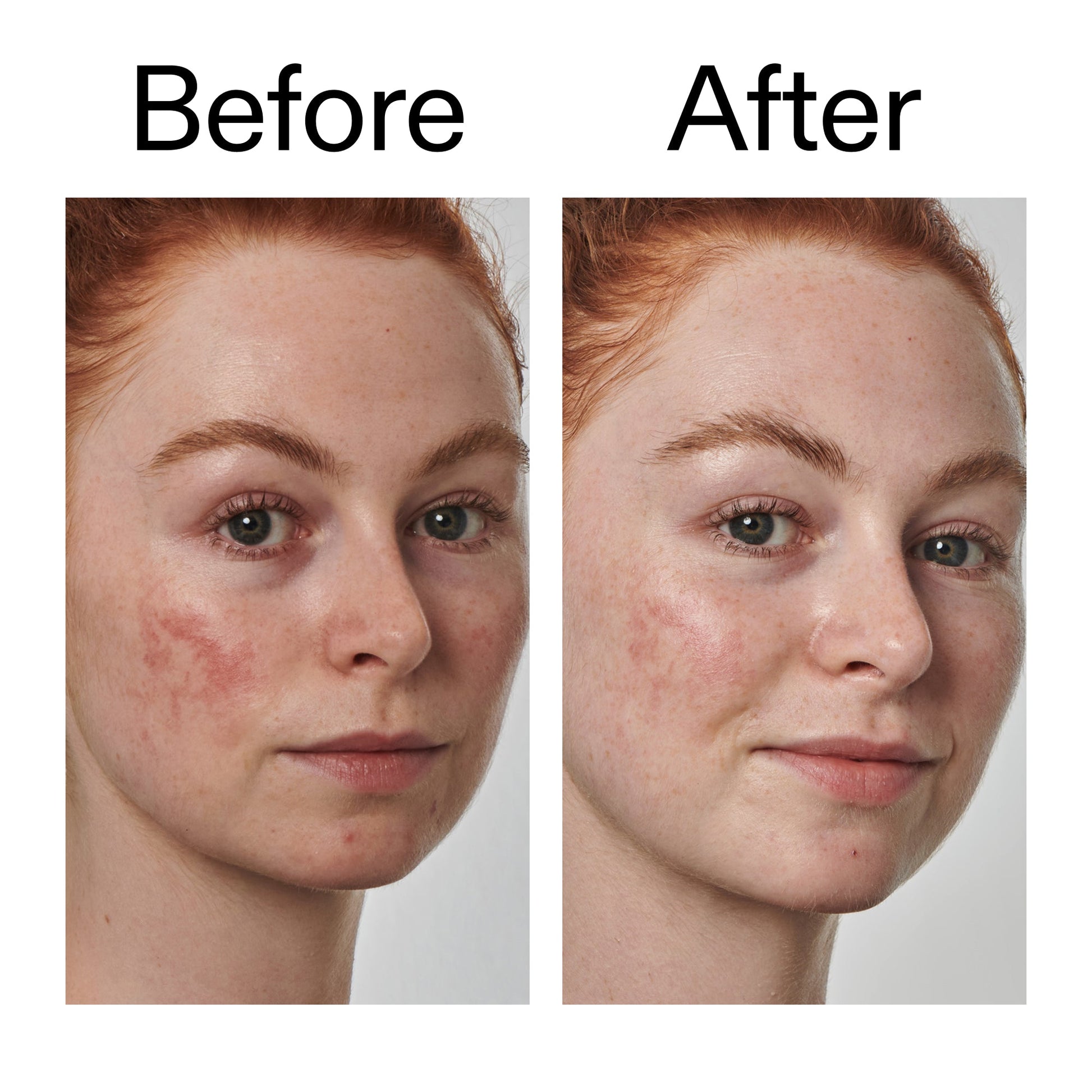 10-azelaic-acid-serum-for-redness-relief-a2 Redness_Relief_Serum_Before_After_2000x2000_3334dc9a-cce9-4e00-8aec-7ad89ca051f2.jpg