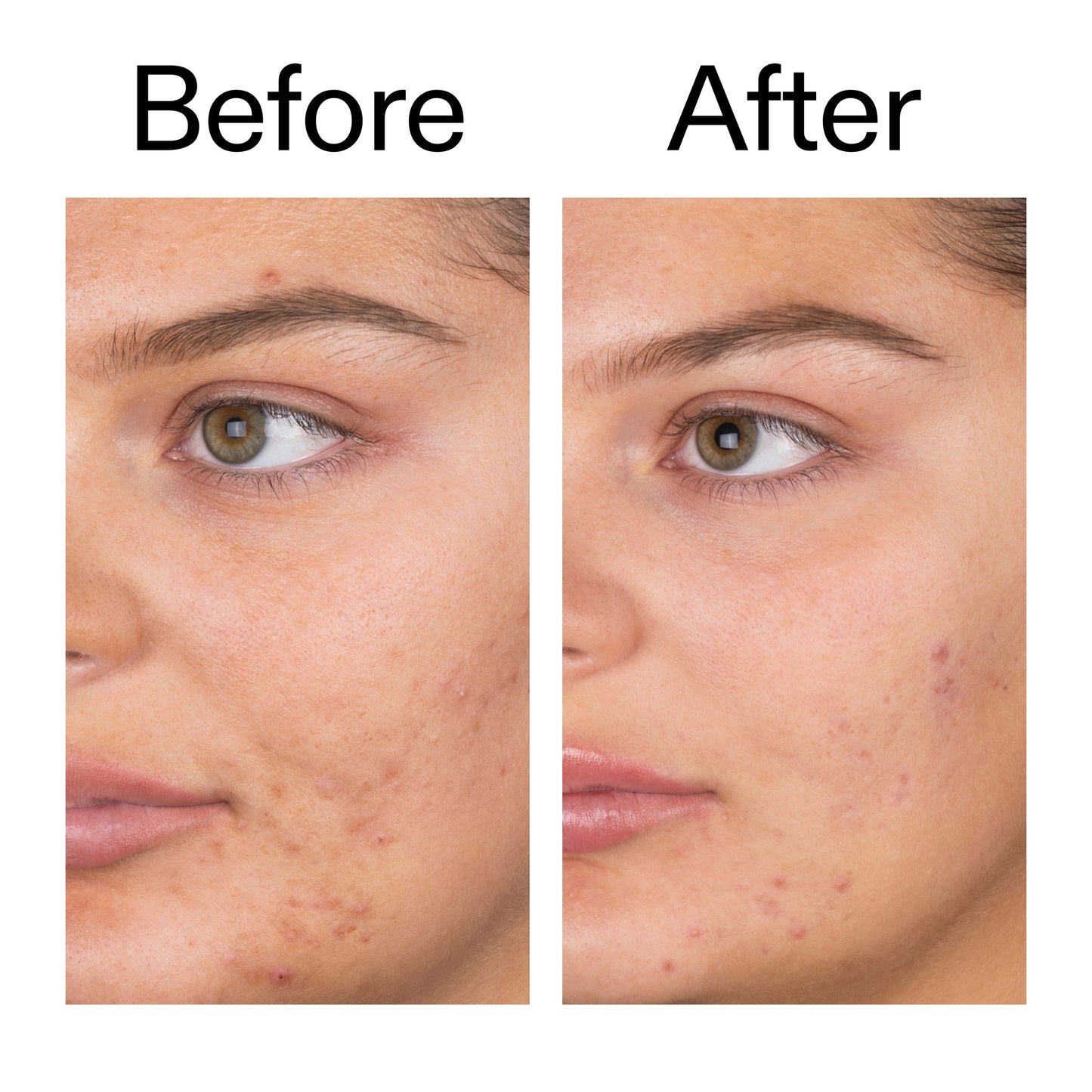 salicylic-acid-cleanser-150ml-f4 Salicylic_Acid_Cleanser_-_150ml_Before_After_2000x2000_e7230494-853f-4b07-82b1-27669104c995.jpg