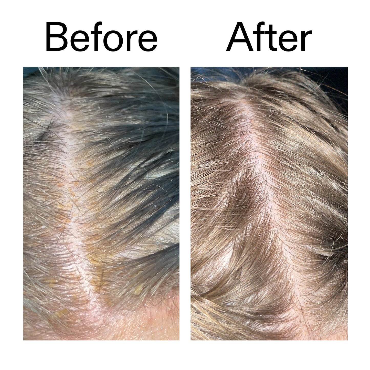 salicylic-acid-exfoliating-scalp-treatment-x0 Salicylic_Acid_Exfoliating_Scalp_Treatment_Before_After_2000x2000_e572a30f-057c-4a48-823b-1c09dc97f8d0.jpg