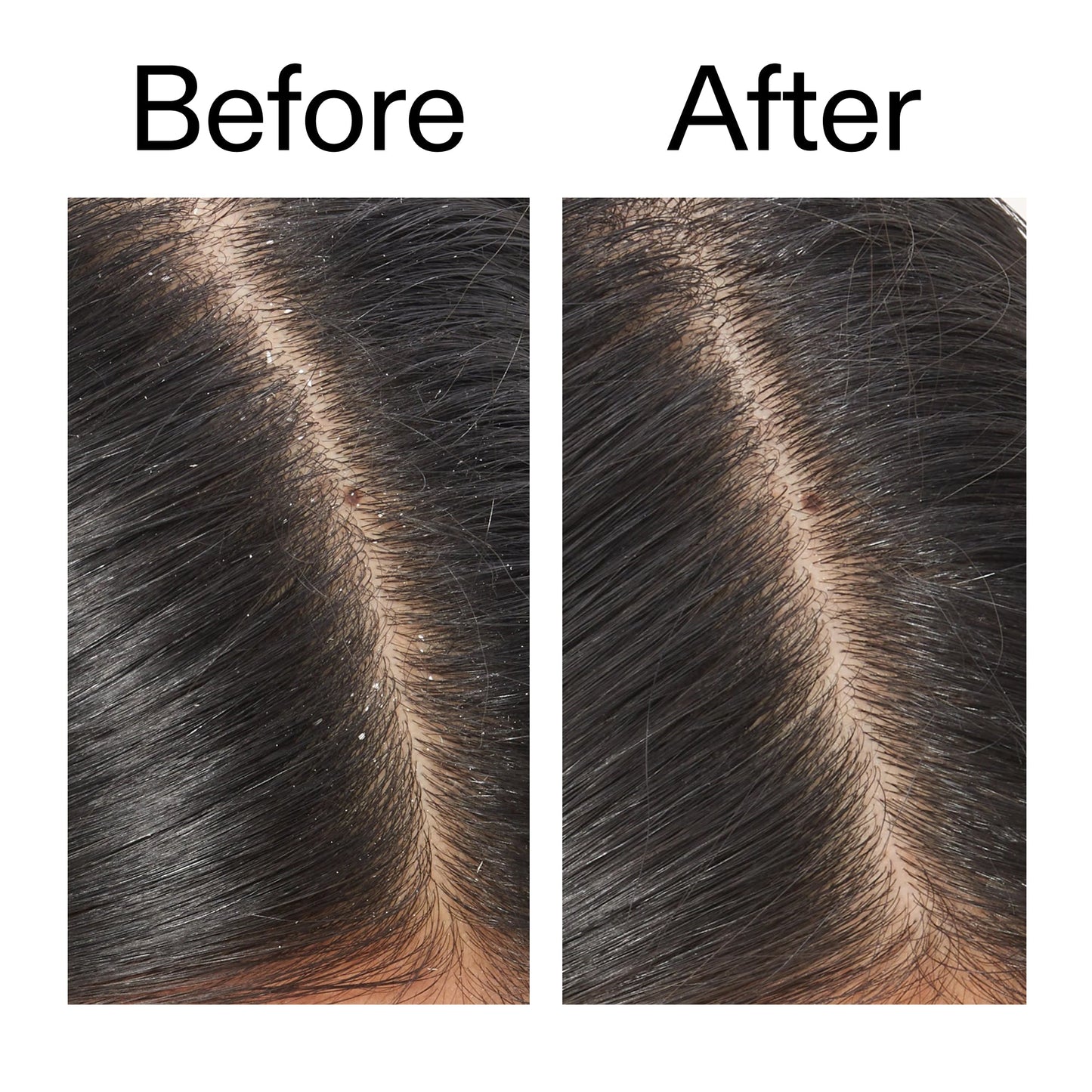 salicylic-acid-exfoliating-scalp-treatment-x0 Salicylic_Acid_Exfoliating_Scalp_Treatment_Before_After_V2_2000x2000_02bd61ad-42bf-490b-b3e3-7e04b2e8a673.jpg