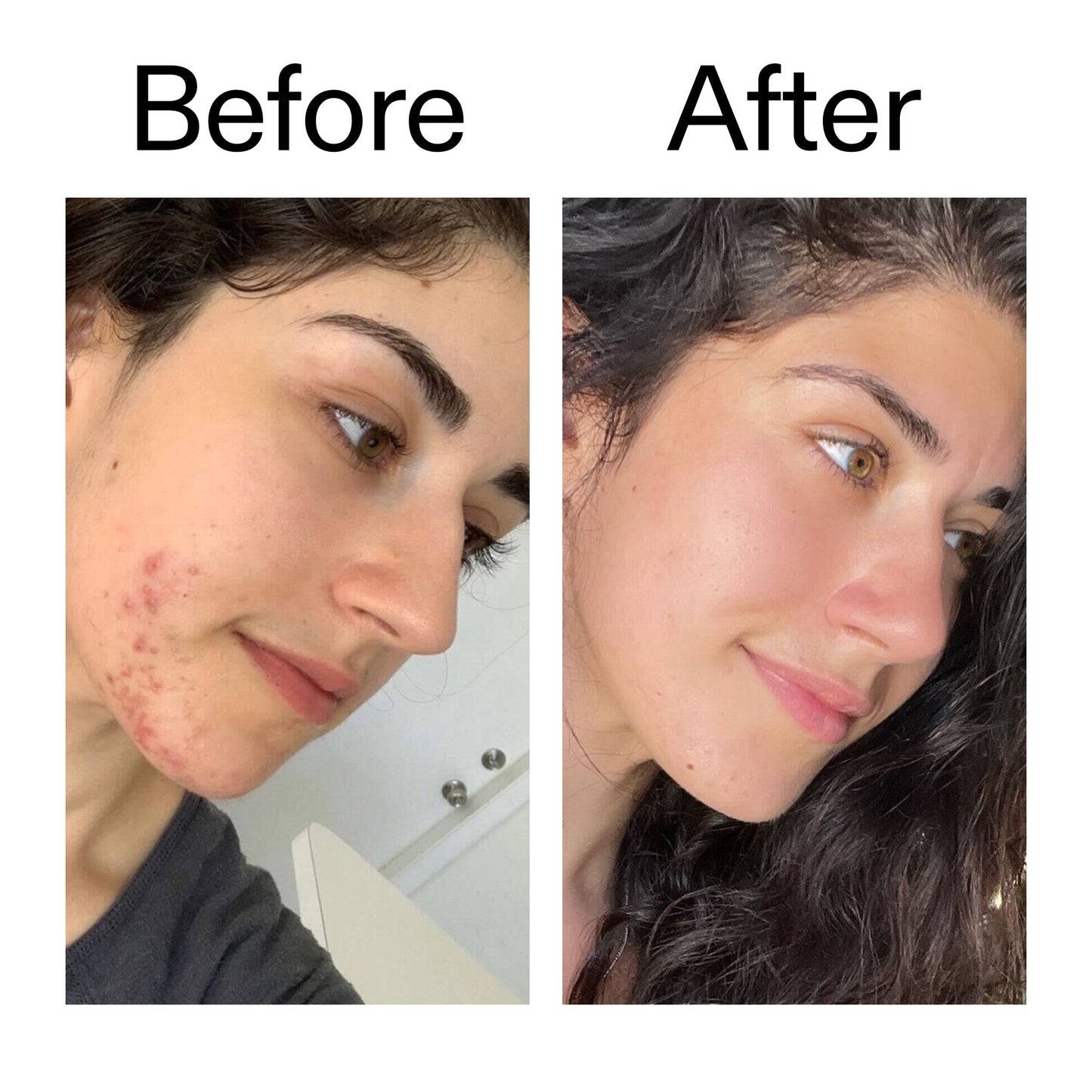 succinic-acid-acne-treatment-e6 Succinic_Acid_Treatment_Before_After_2000x2000_6a5f0054-2f58-4433-9314-0dc72c9bdd3b.jpg