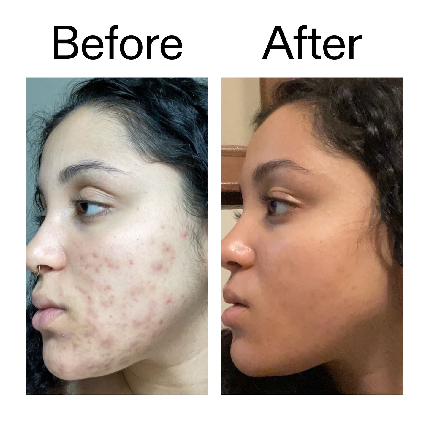 tranexamic-acid-serum-v3 Tranexamic_Acid_Serum_Before_After_2000x2000_98ebc8be-77b0-4843-8a22-90790ebe918b.jpg